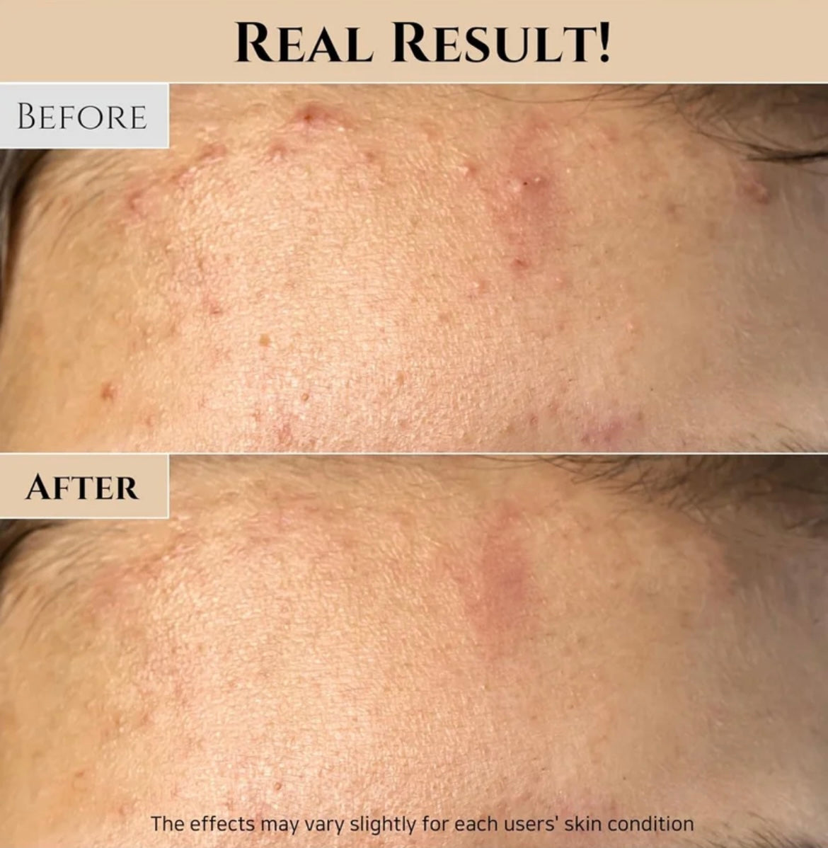 Crème hydra acné
